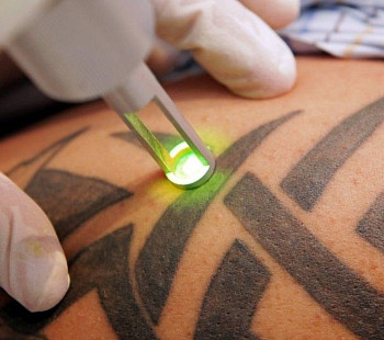 Студия удаления тату и лазерной эпиляции в ЦАО